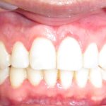 Traitement orthodontique après