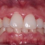 Traitement orthodontique avant