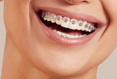 Appareils Dentaires | Traitement orthodontique | Orthodontic studio