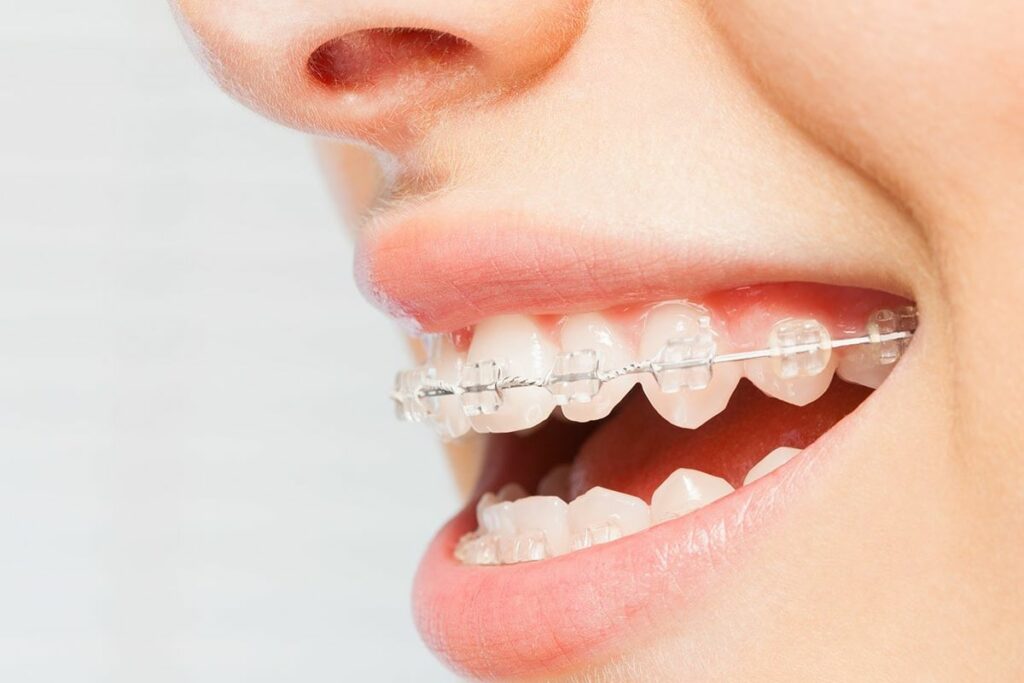 L’appareillage orthodontique Céramique